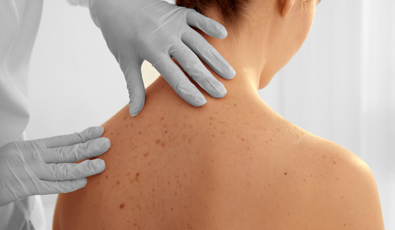 Sırtta sivilce neden olur?